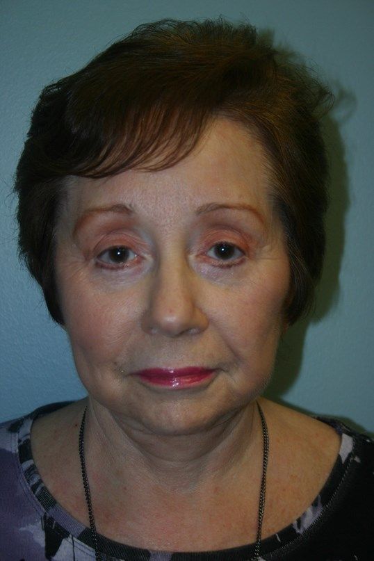 Injectable Fillers Before & After