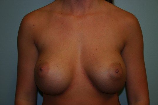 Breast Revision Before & After