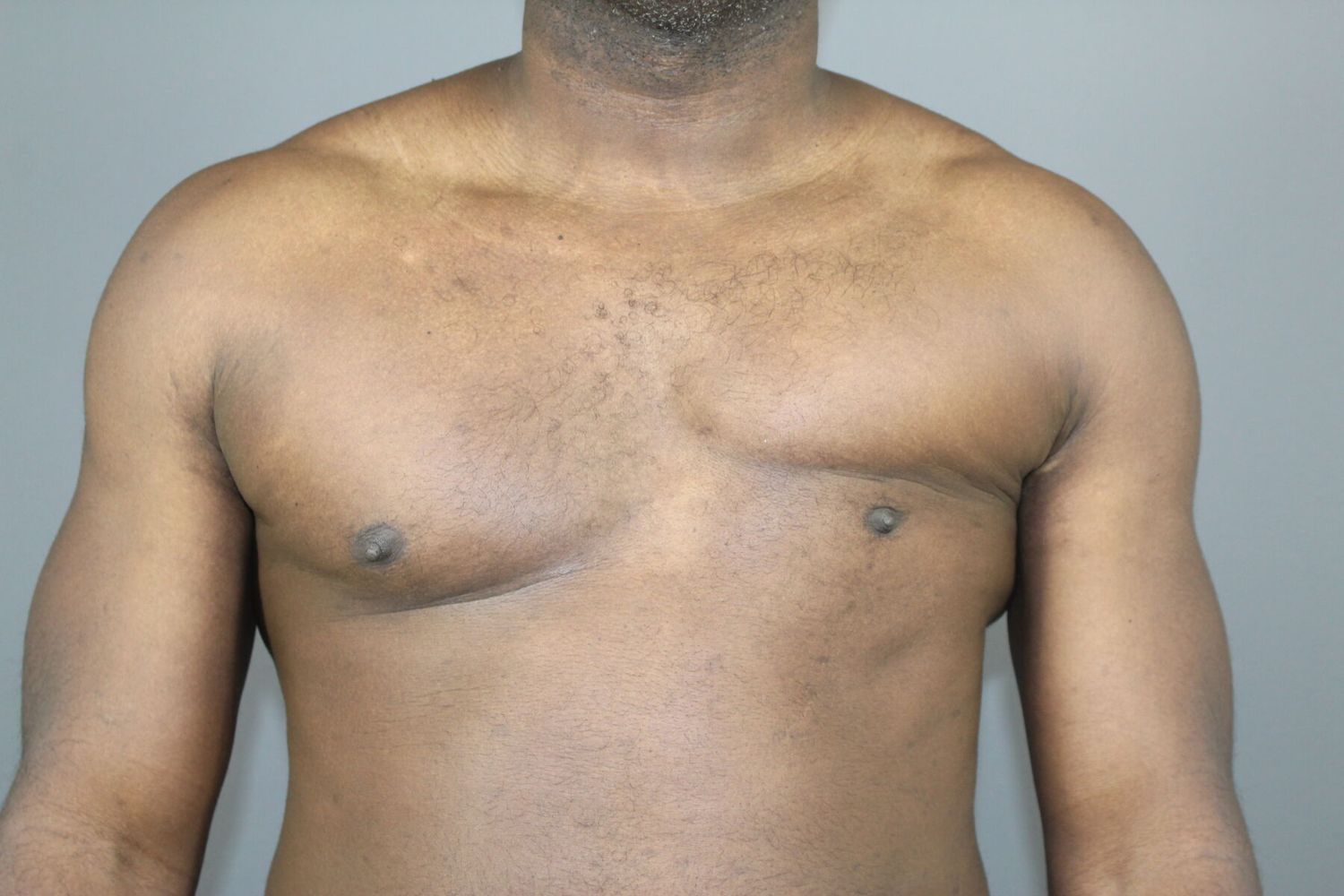 Polands Syndrome Before & After