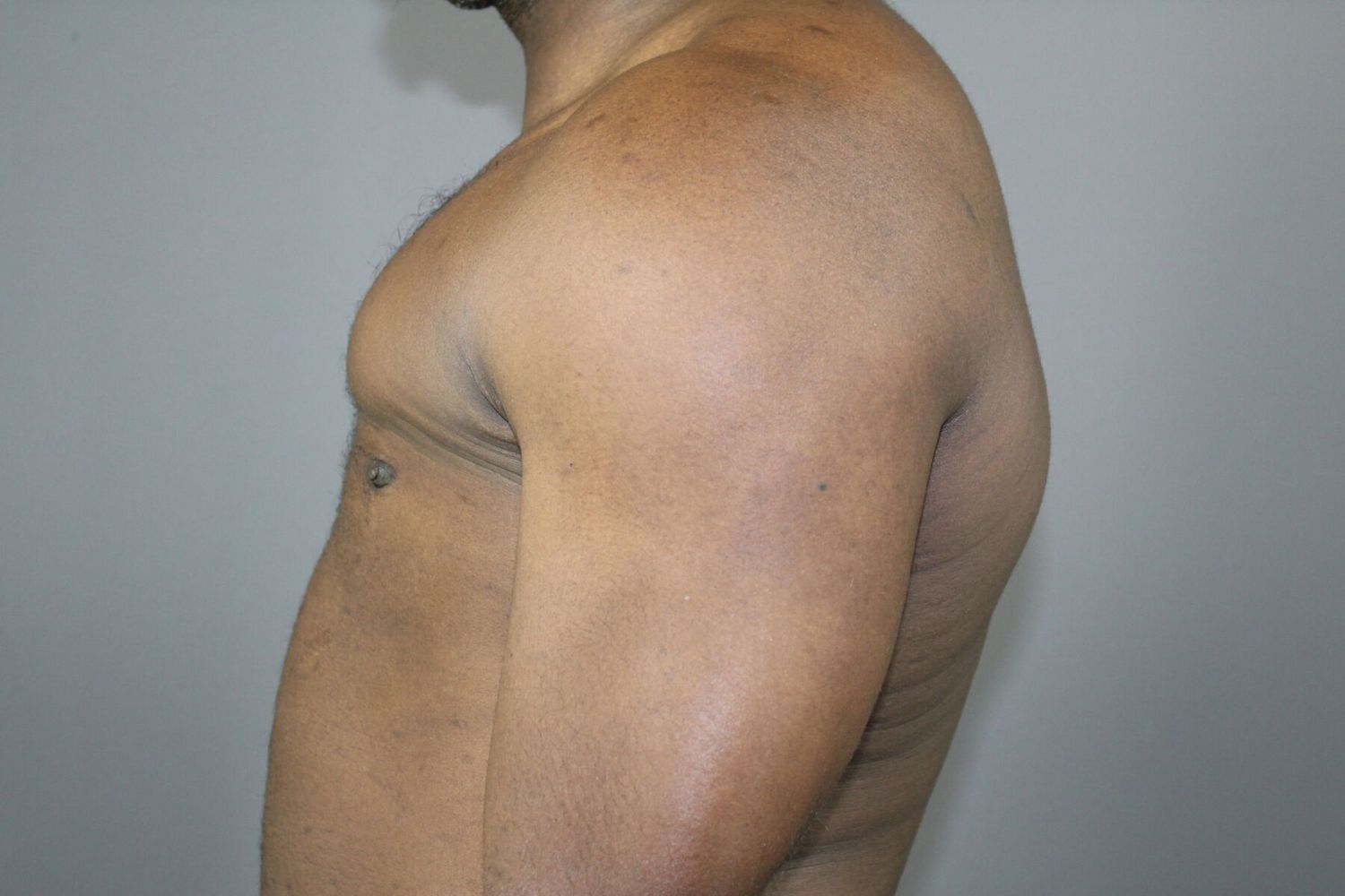 Polands Syndrome Before & After