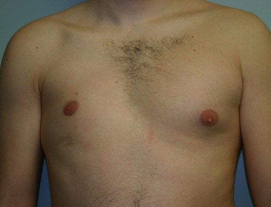 Polands Syndrome Before & After