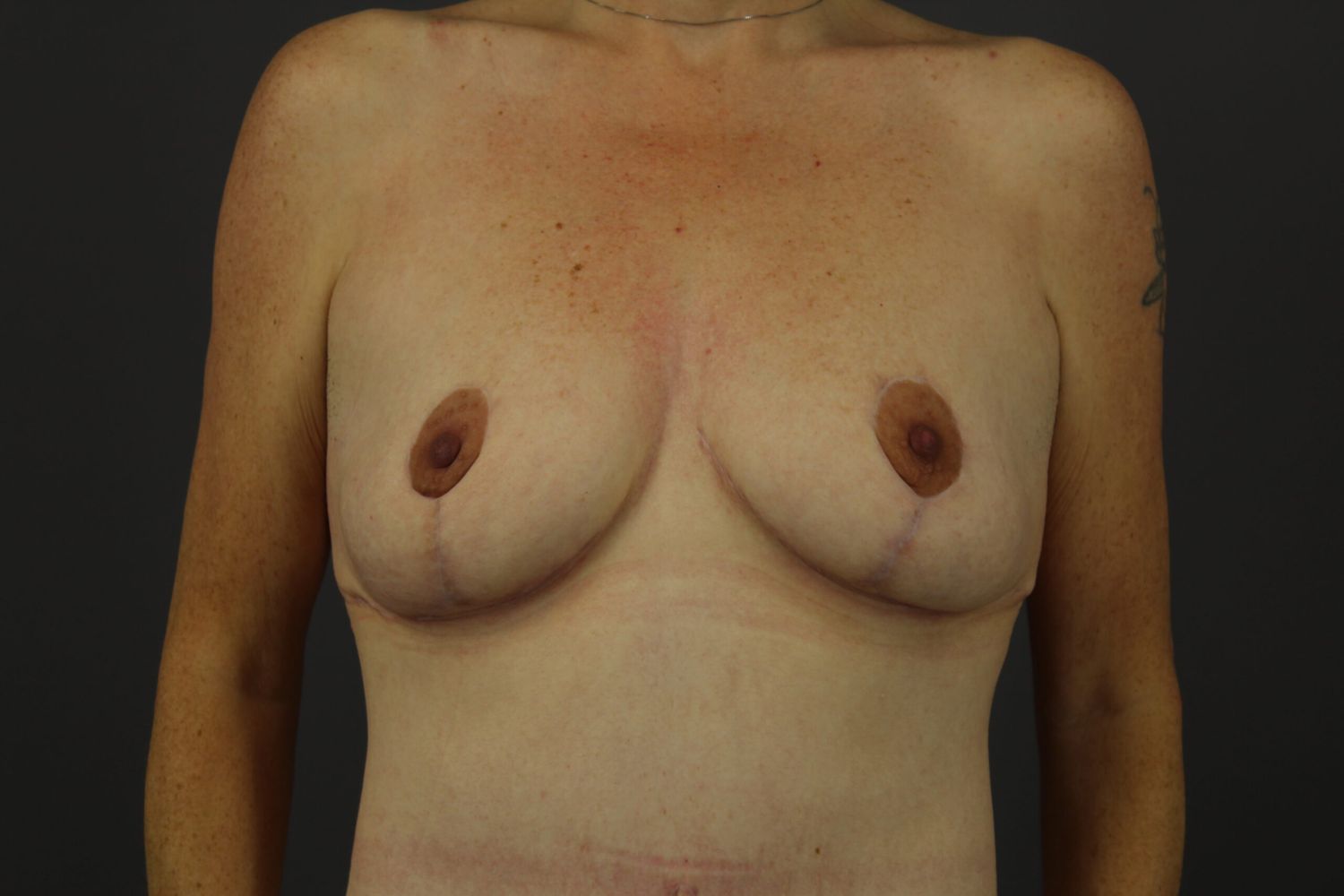 Breast Lift Before & After