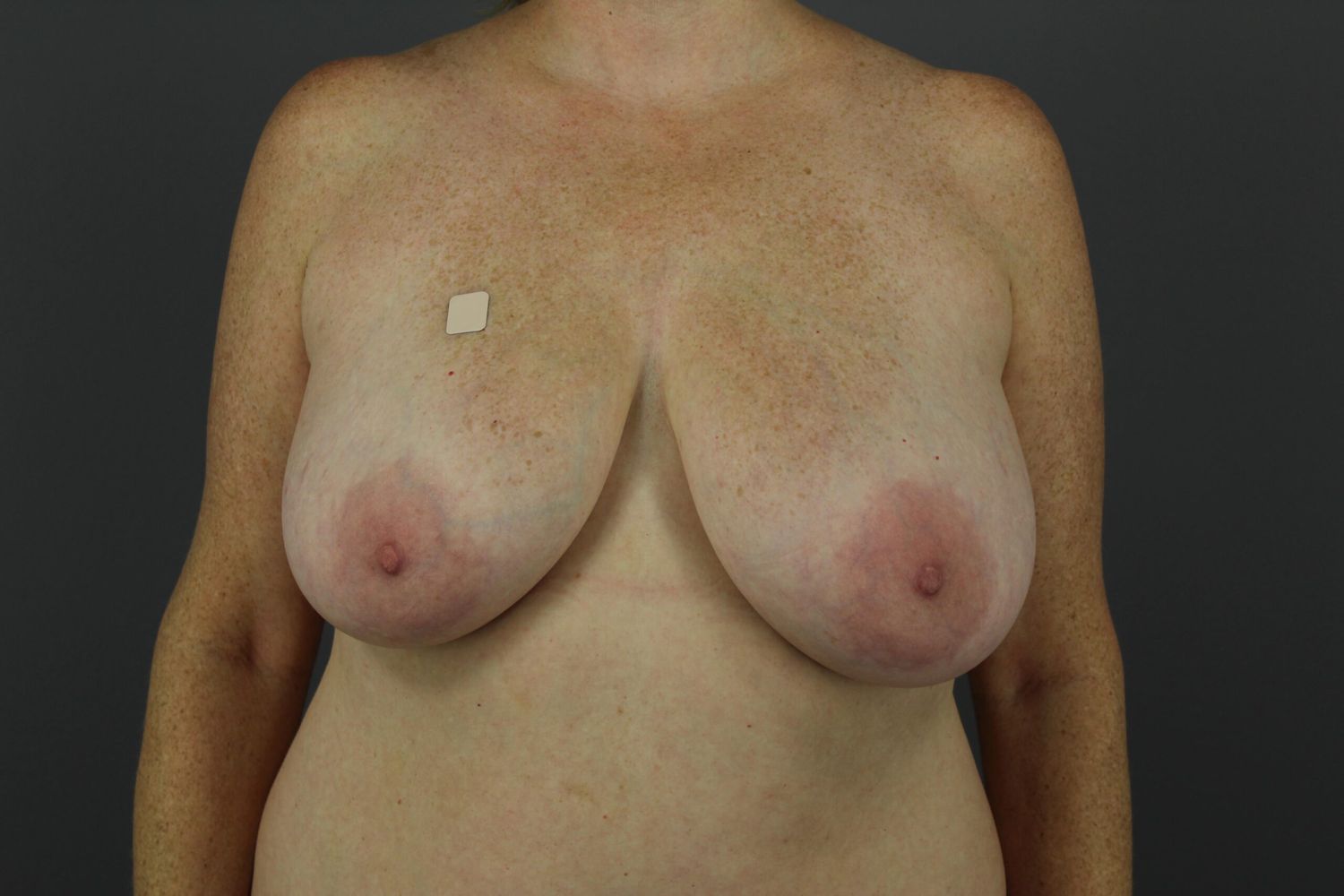 Breast Lift Before & After