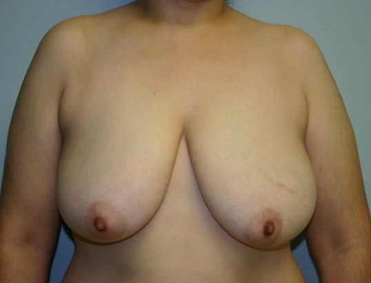 Breast Lift Before & After