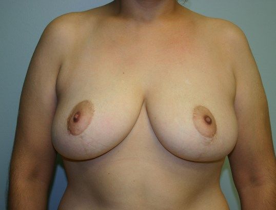 Breast Lift Before & After