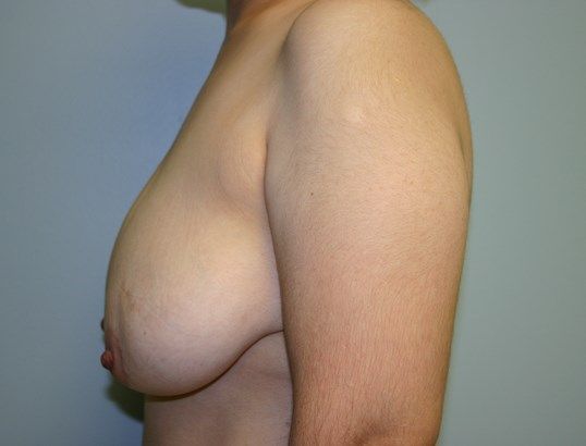 Breast Lift Before & After