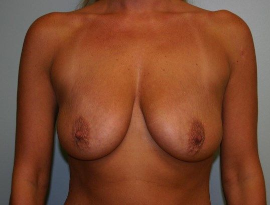 Breast Lift Before & After