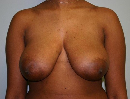 Breast Lift Before & After