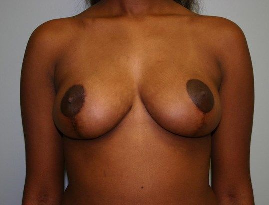 Breast Lift Before & After