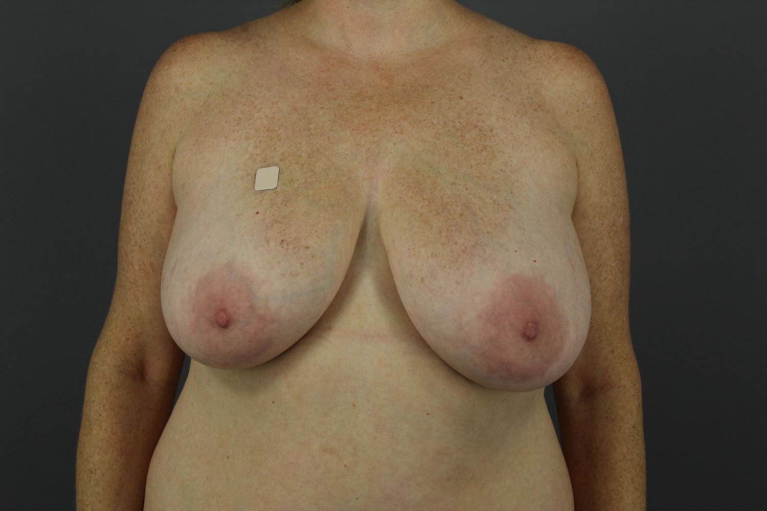 Breast Lift Before & After
