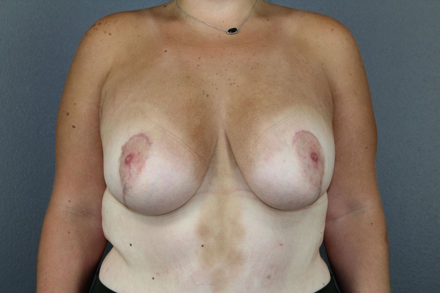 Breast Lift Before & After