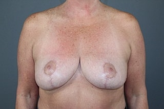 Breast Lift Before & After