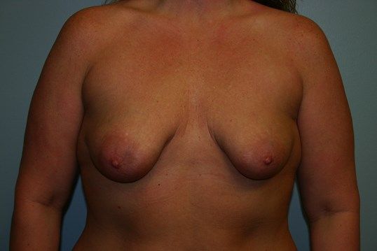 Breast Lift Before & After