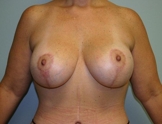Breast Lift Before & After