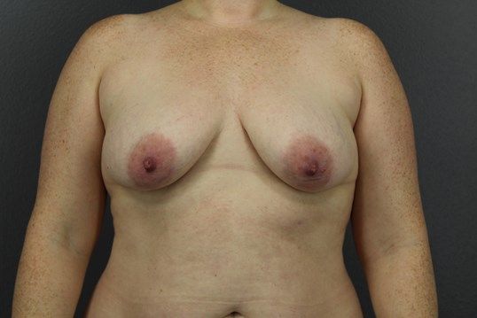Breast Lift Before & After