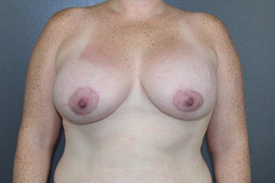 Breast Lift Before & After