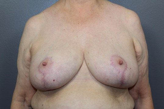 Breast Lift Before & After