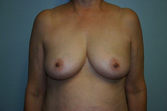 Breast Lift Before & After