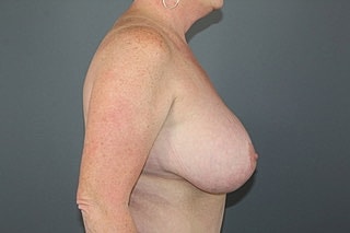 Breast Lift Before & After