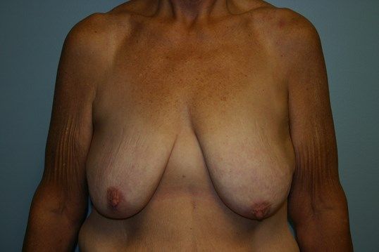 Breast Lift Before & After