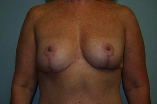 Breast Lift Before & After