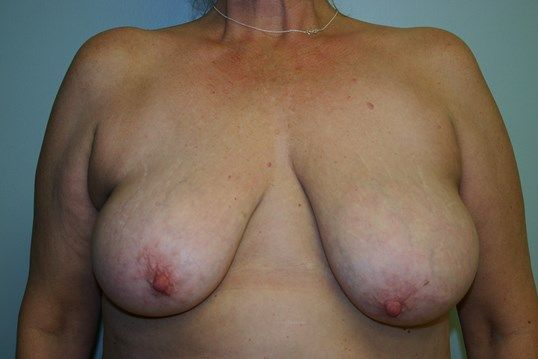 Breast Lift Before & After