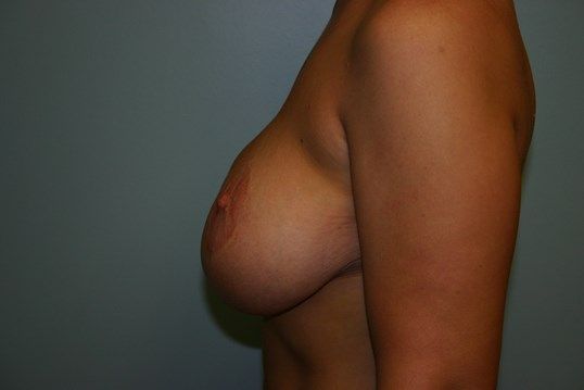Breast Lift Before & After