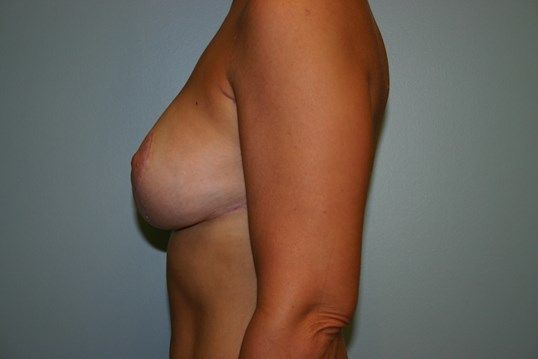 Breast Lift Before & After