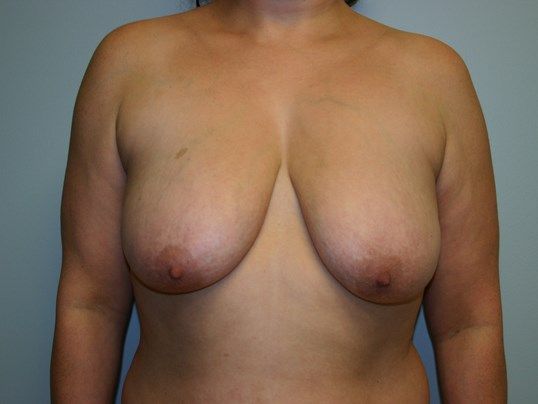 Breast Lift Before & After