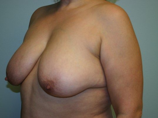 Breast Lift Before & After