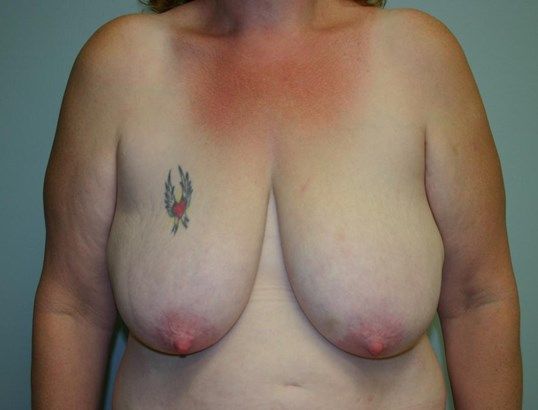 Breast Lift Before & After