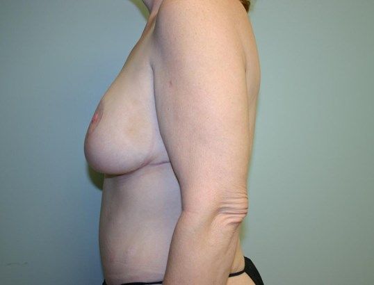 Breast Lift Before & After