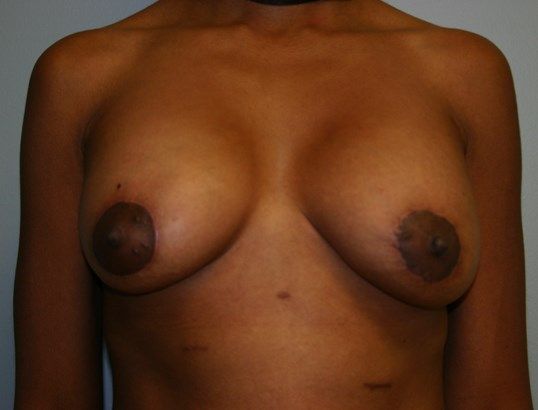 Breast Lift Before & After