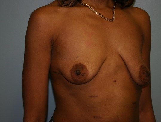 Breast Lift Before & After