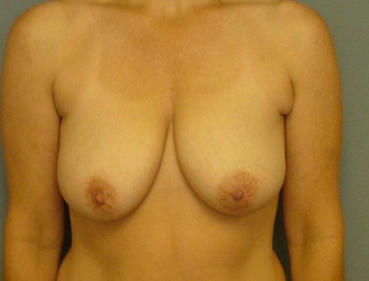 Breast Lift Before & After