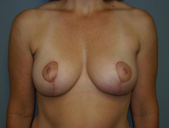 Breast Lift Before & After