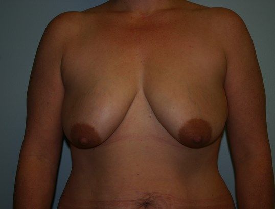 Breast Lift Before & After