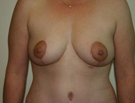 Breast Lift Before & After