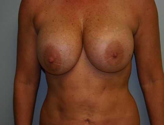 Breast Lift Before & After