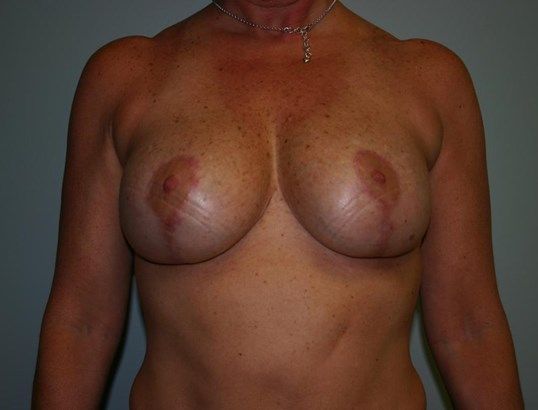 Breast Lift Before & After