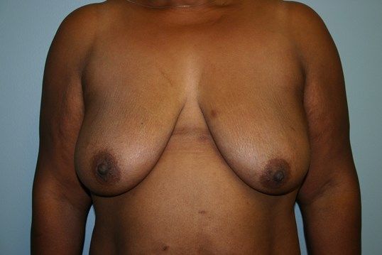 Breast Lift Before & After