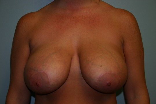 Breast Lift Before & After