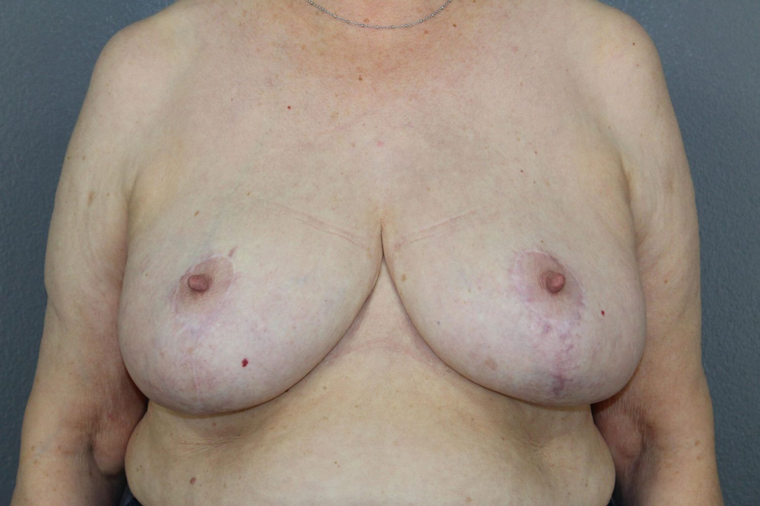 Breast Lift Before & After