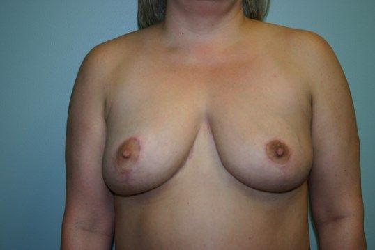 Breast Lift Before & After