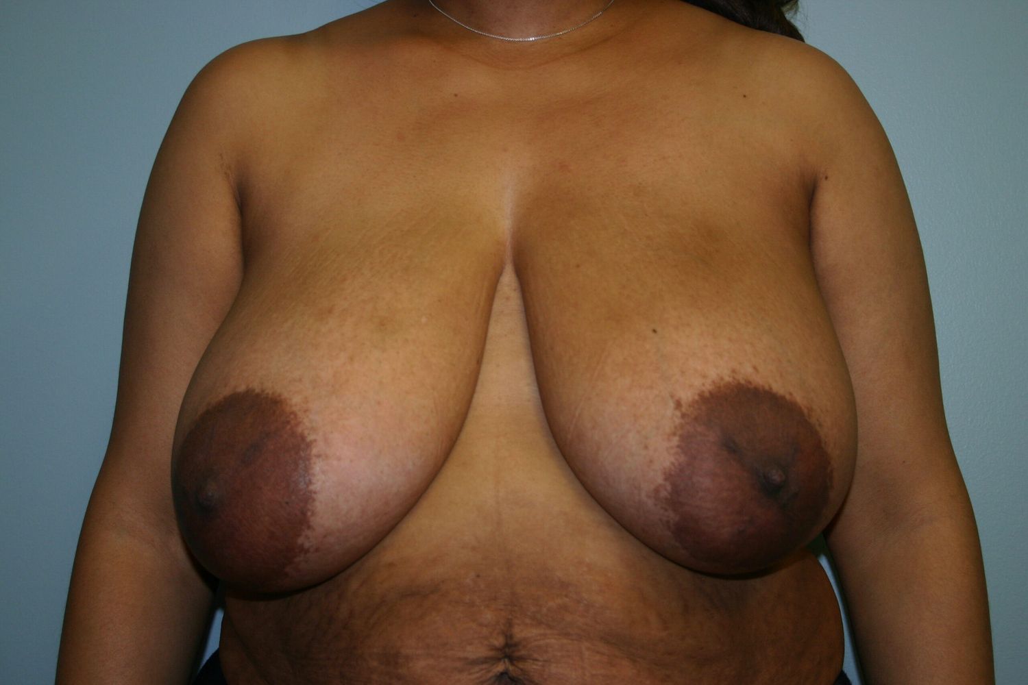Breast Lift Before & After