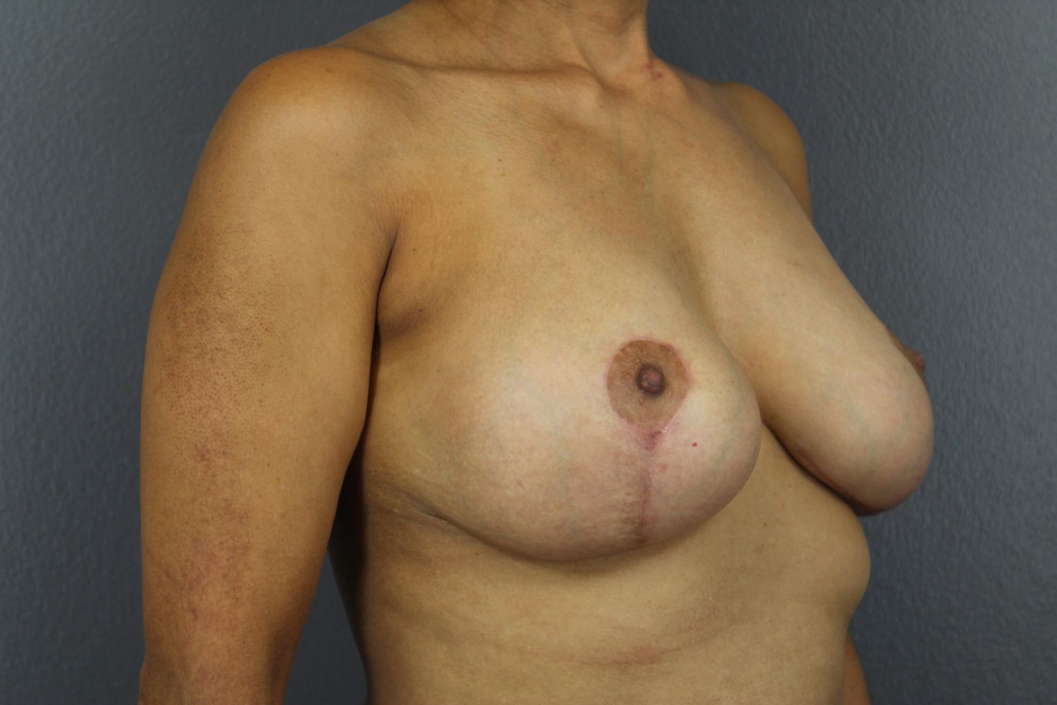 Breast Lift Before & After