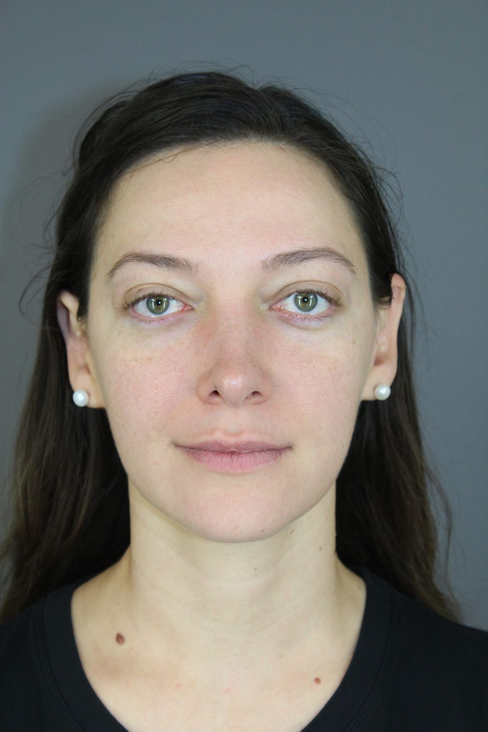 Rhinoplasty Before & After