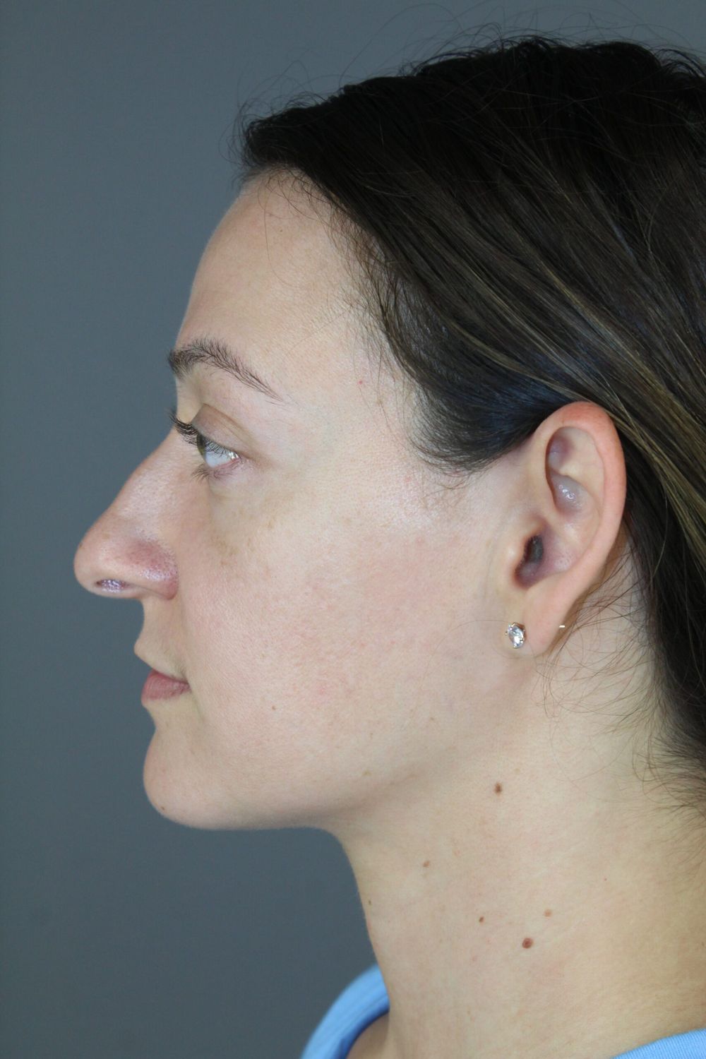 Rhinoplasty Before & After
