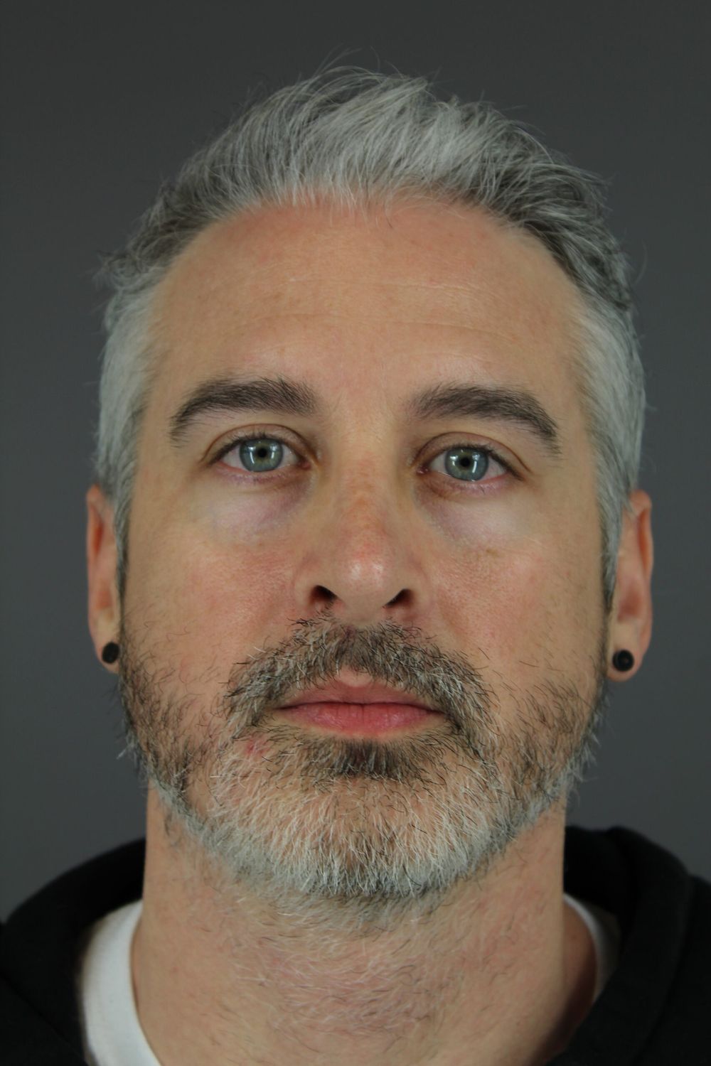 Rhinoplasty Before & After