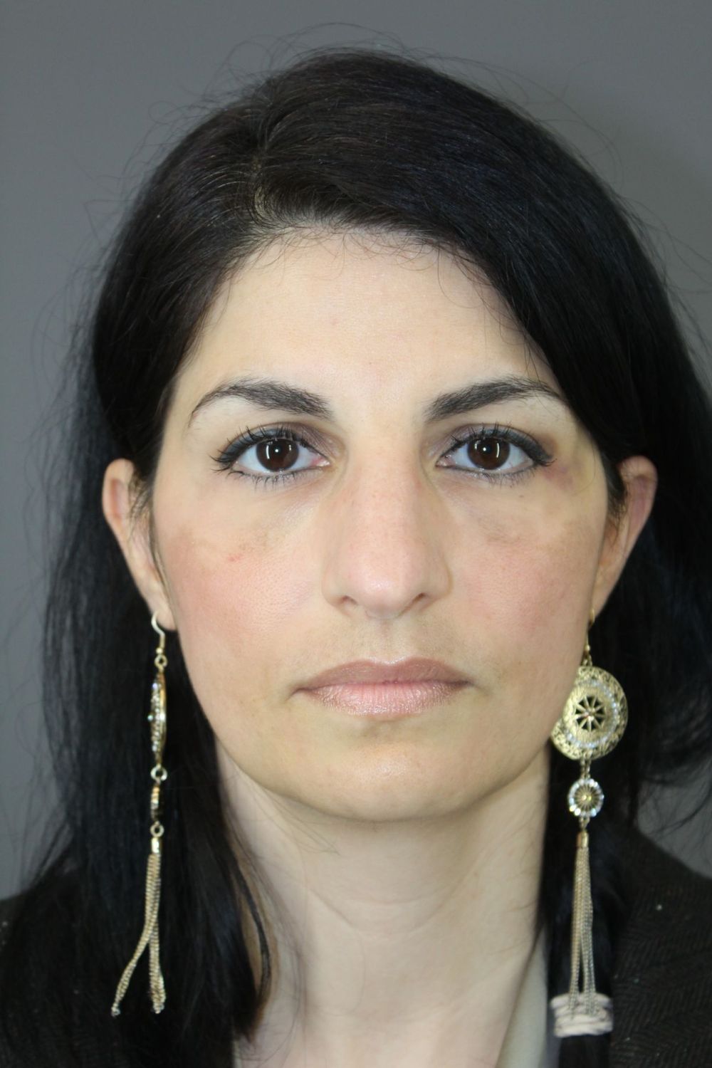 Rhinoplasty Before & After